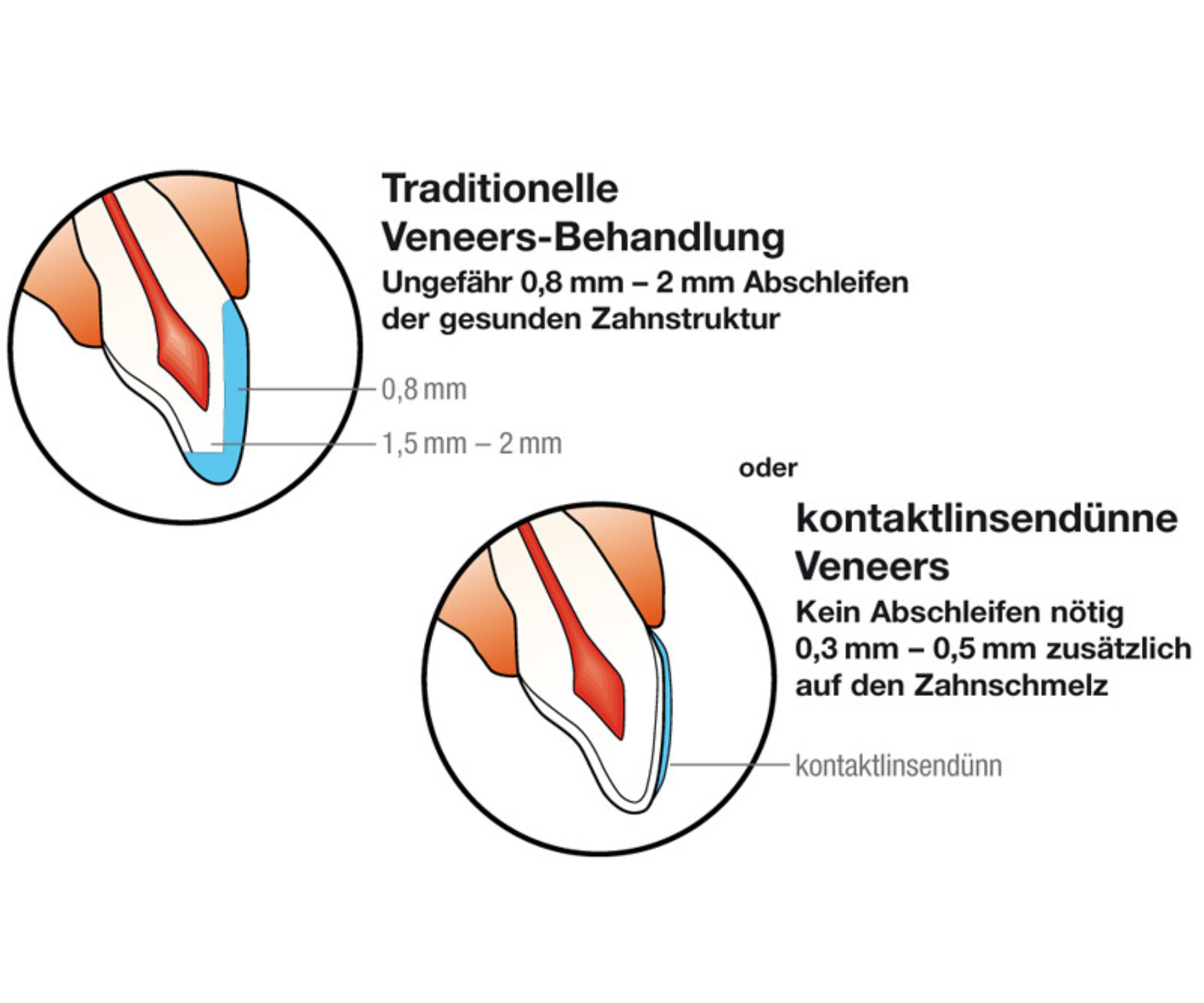 Grafik zum Vergleich No-Prep-Veneers und traditionelle Veneers bei St. Albantor Zahnarzt in Basel
